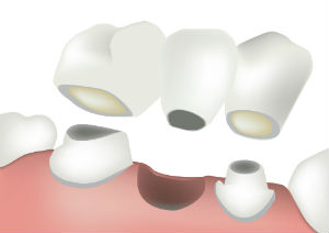 Dental Bridges | Everett Dental Associates | Dentist Everett, MA