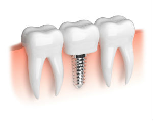 Implants Available | Everett Dental Associates